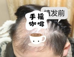 -大麦微针植发全国连锁