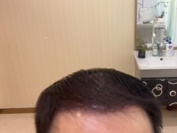 -碧莲盛·不剃发植发