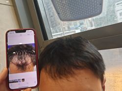 -碧莲盛·不剃发植发