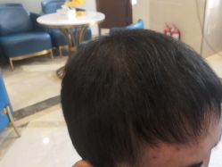 -碧莲盛·不剃发植发