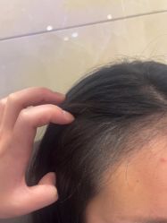 -碧莲盛·不剃发植发