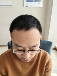 体验后-大麦微针植发丨全国连锁