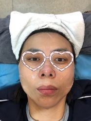 体验后-More摩尔医美の注射线雕光电中心