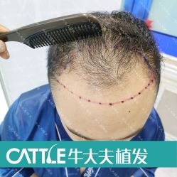 体验前-牛大夫植发