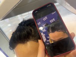 -碧莲盛·不剃发植发