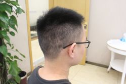 点击看大图 -大麦微针植发丨全国连锁