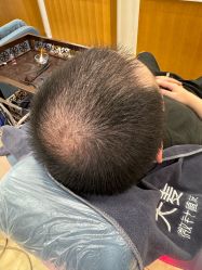 -大麦微针植发全国连锁