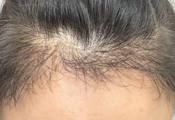 -碧莲盛·不剃发植发