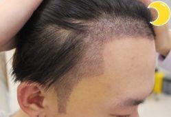 -大麦微针植发丨全国连锁