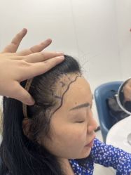 点击看大图 -大麦微针植发全国连锁