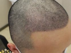 -大麦微针植发丨全国连锁