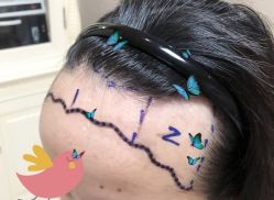 -大麦微针植发全国连锁