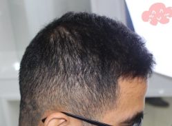 -大麦微针植发丨全国连锁