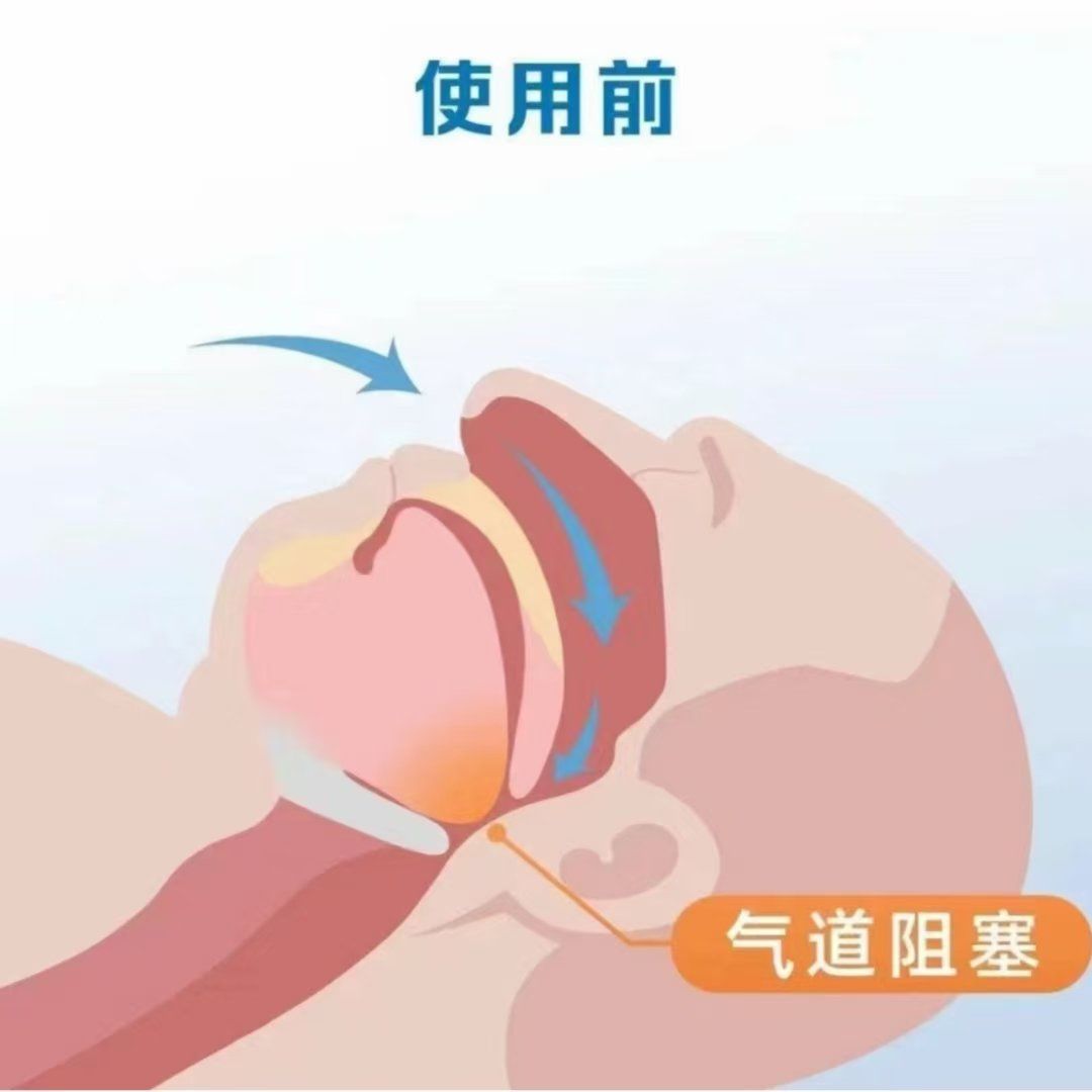 家用睡眠止鼾呼吸机通过持续正压通气(cpap)技术,帮助保持呼吸道畅通