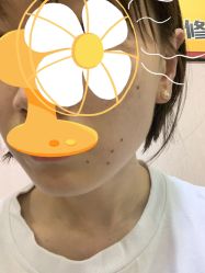 -北京美痣堂古方祛痣斑疣瘊