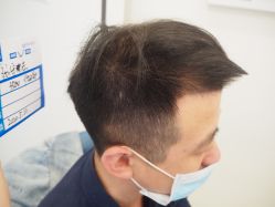 -大麦微针植发丨全国连锁