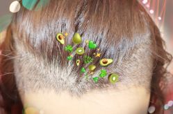 -大麦微针植发全国连锁