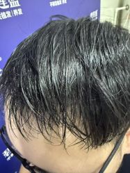 -碧莲盛·不剃发植发