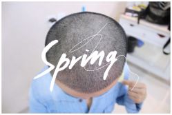 体验后-大麦微针植发全国连锁