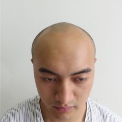 -碧莲盛·不剃发植发