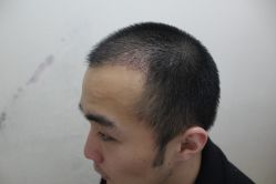 点击看大图 -大麦微针植发丨全国连锁