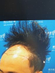 体验前-雍禾植发全国连锁