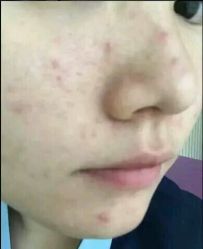-苗方清颜专业祛痘