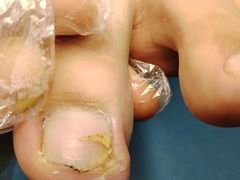 -祖传修脚甲沟炎灰指甲鸡眼