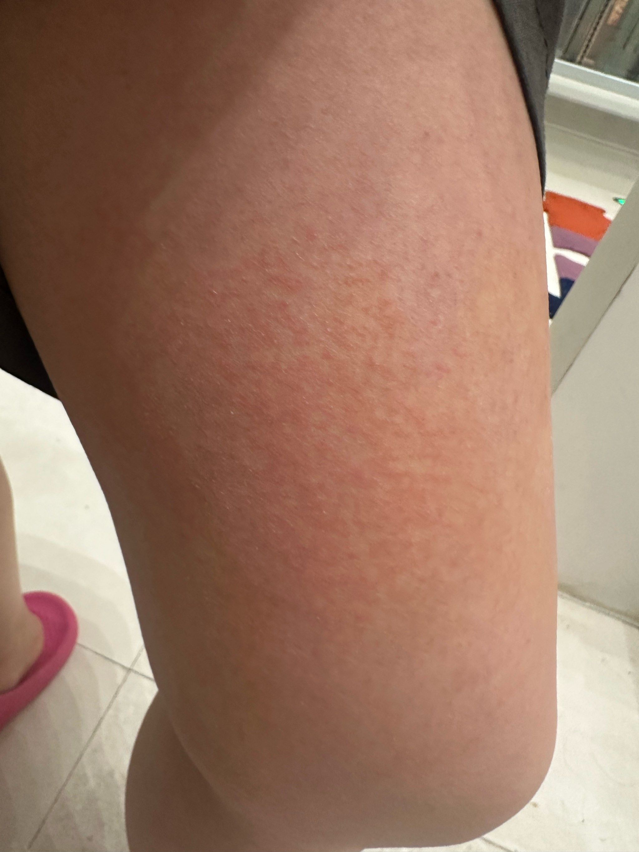 两条腿起的全是红疙瘩