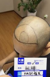 -大麦微针植发全国连锁