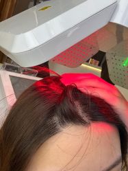 -大麦微针植发全国连锁