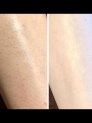 -薇兰专业脱毛连锁机构