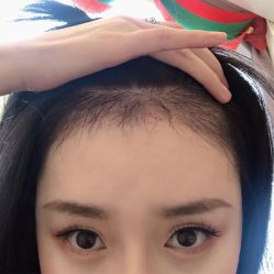 -碧莲盛·不剃发植发