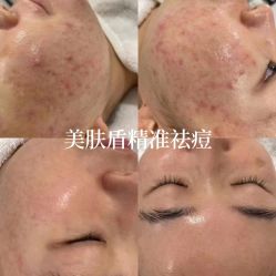 -美肤盾祛痘·问题肌头疗管理中心