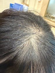 -碧莲盛·不剃发植发