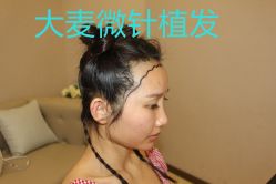 -大麦微针植发丨全国连锁