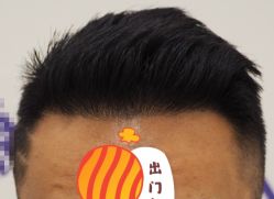 -大麦微针植发全国连锁