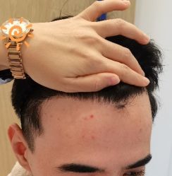 -大麦微针植发丨全国连锁