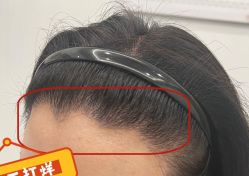 -大麦微针植发全国连锁