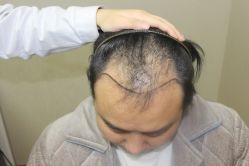 体验前-大麦微针植发全国连锁