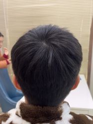 -大麦微针植发丨全国连锁