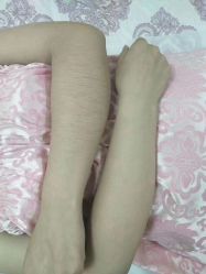 -薇兰专业脱毛连锁机构