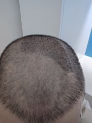 -大麦微针植发丨全国连锁