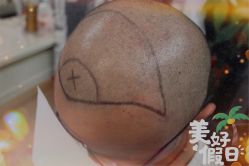-大麦微针植发全国连锁