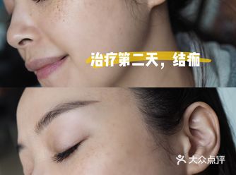 皮秒祛斑分享|不要做“斑点”女孩！