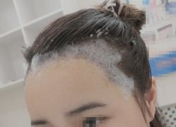 -大麦微针植发丨全国连锁