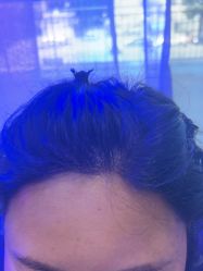 -碧莲盛·不剃发植发