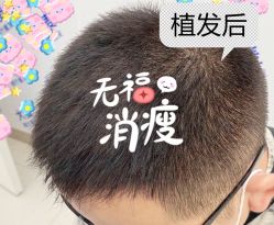 -大麦微针植发全国连锁