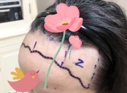 -大麦微针植发全国连锁