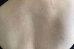 -爱莎扁平疣·汗管瘤·斑痣中心